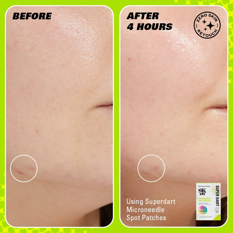 Revolution Skincare Spotted Microneedle Spot Patches 9 Pieces